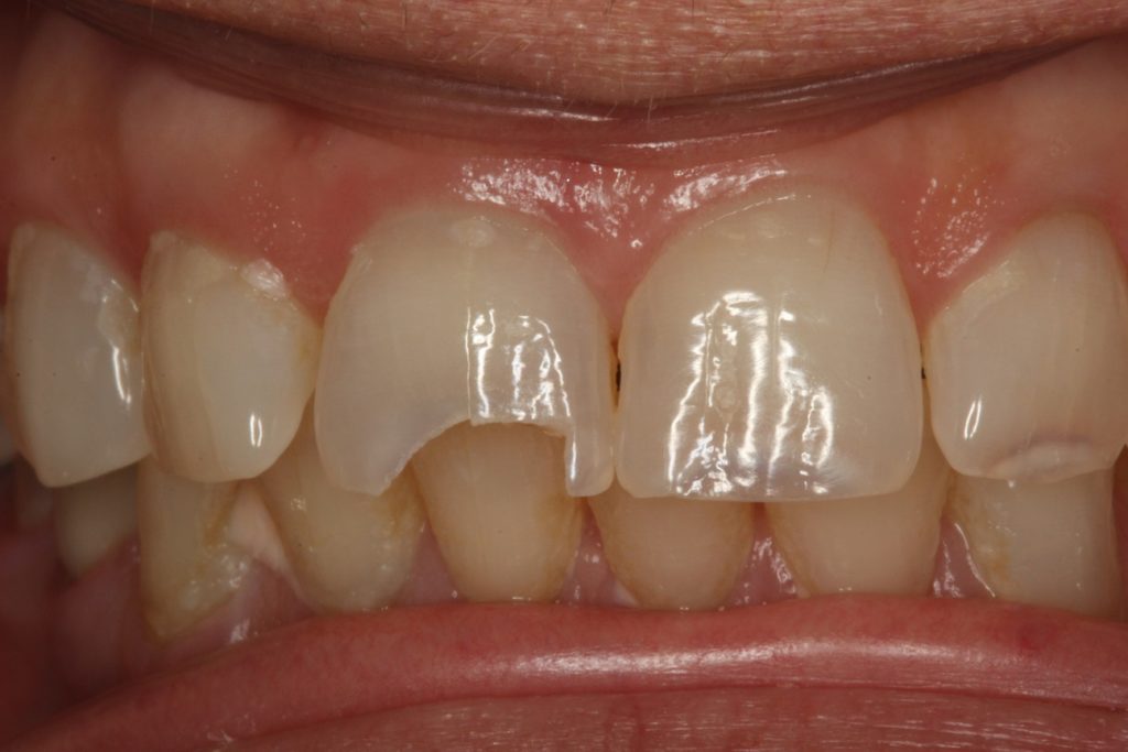 Before undergoing dental bonding treatment with Dr. Scott Coleman.