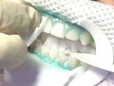 The second step of Zoom Whitening is a rubber coating being applied over your gum tissue to protect your gums.
