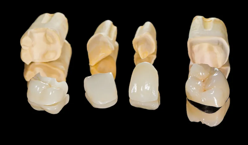 Crowning Achievements In Dentistry