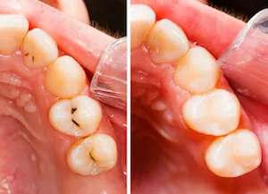 Think You May Have A Cavity?