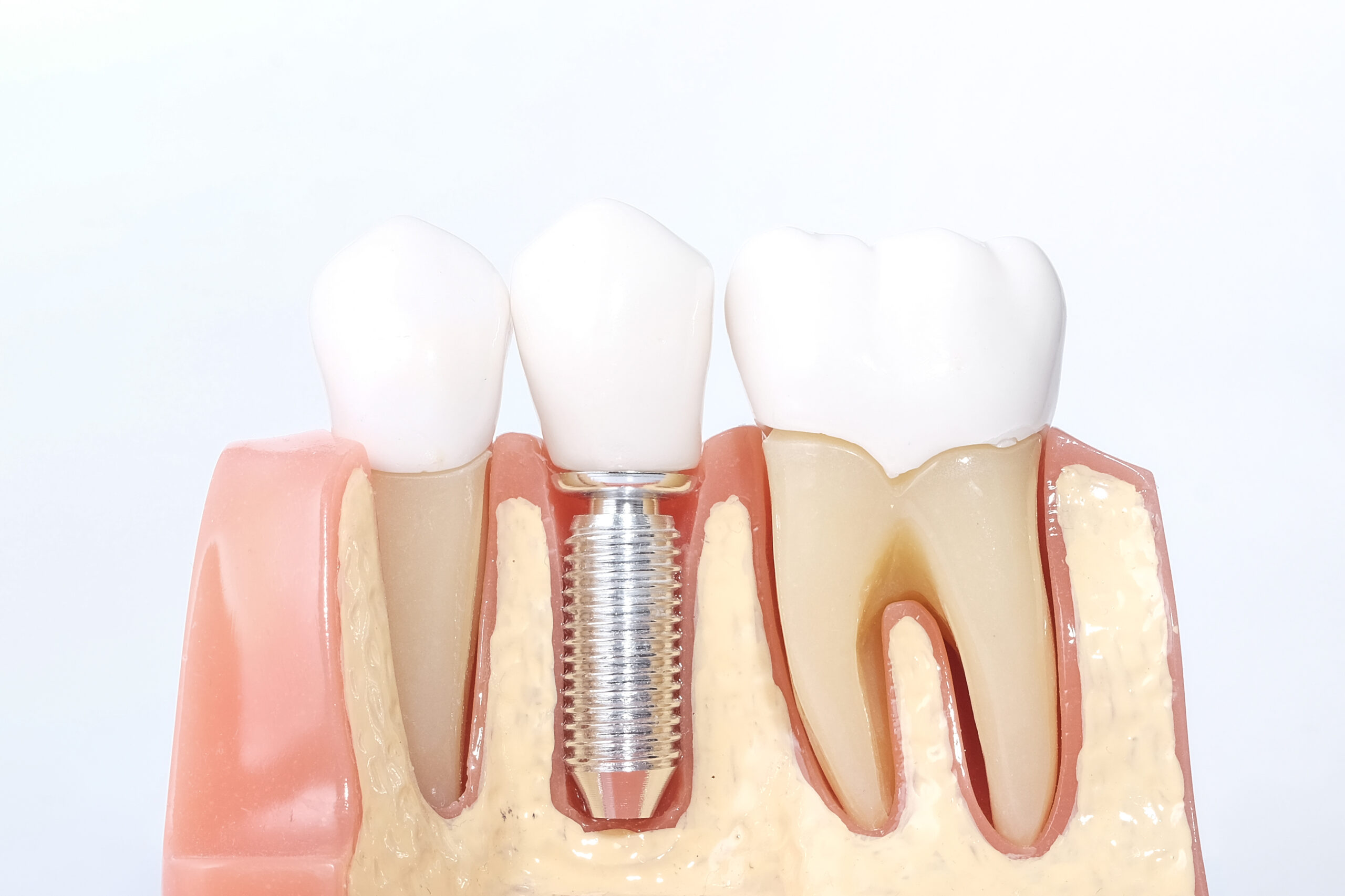 Understanding the Difference Between Dental Implants and Bridges in Houston