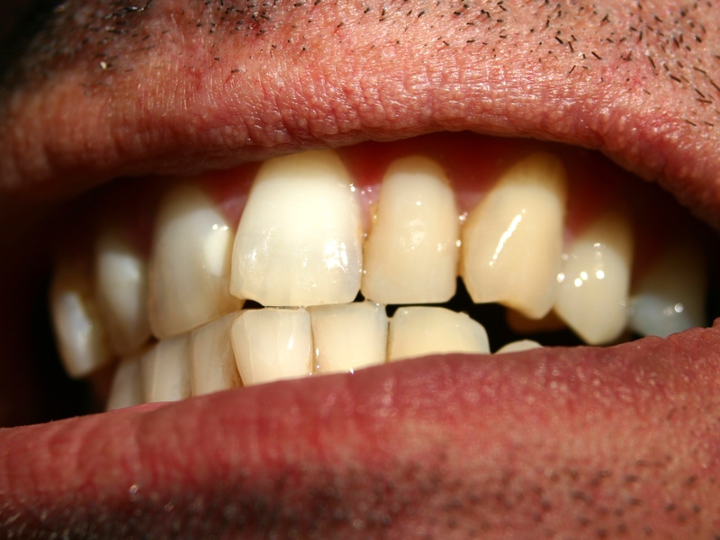 Straightening Smiles and Crooked Teeth at Coleman Dental
