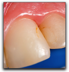 Brush Up On Your Cavity Basics in Houston