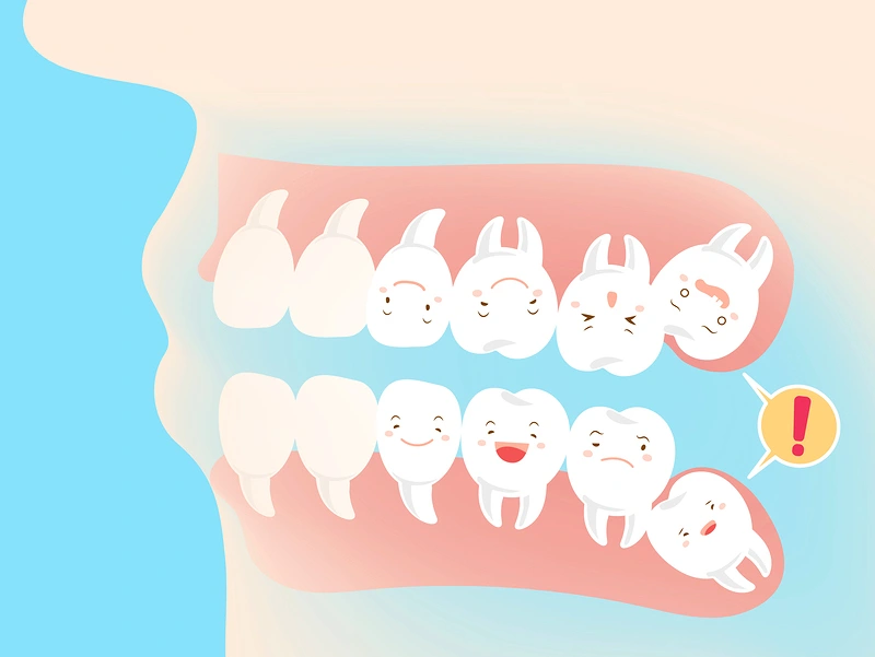 What Are Impacted Wisdom Teeth?