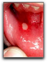 Is Your Mouth Sore Something Serious?