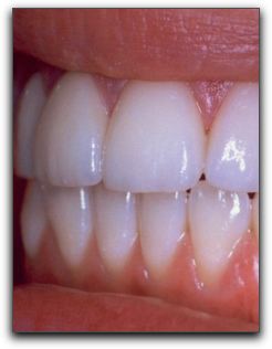 Porcelain Veneers And Instant Orthodontics