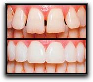 What’s The Latest With Veneers in Houston?