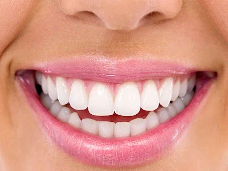 Professional Teeth Whitening In Houston